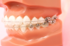 歯列矯正用器具部品